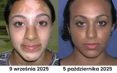 Krem na leczenie bielactwa BeeVenom