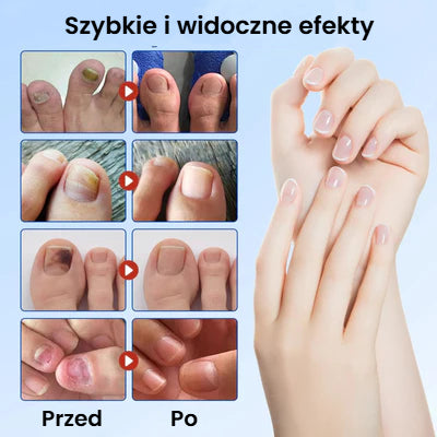 FungalPatch – Antybakteryjny plaster przeciwgrzybiczy i pielęgnacja paznokci