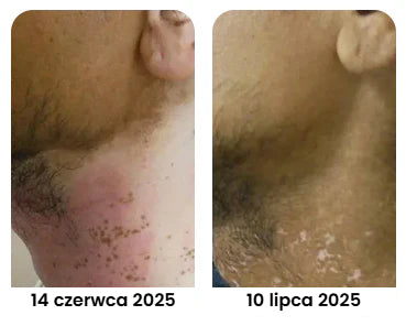 Krem na leczenie bielactwa BeeVenom