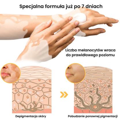 Krem na leczenie bielactwa BeeVenom