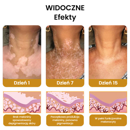 Krem na leczenie bielactwa BeeVenom